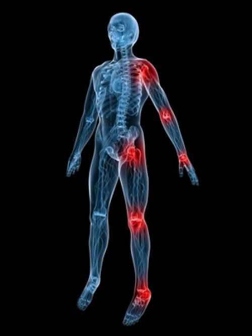 Rheumatoid Arthritis Image